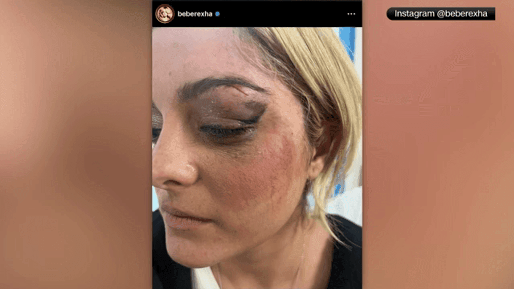 Bebe Rexha suffers black eye after she was hit by cellphone while performing on stage (CNN Newsource)